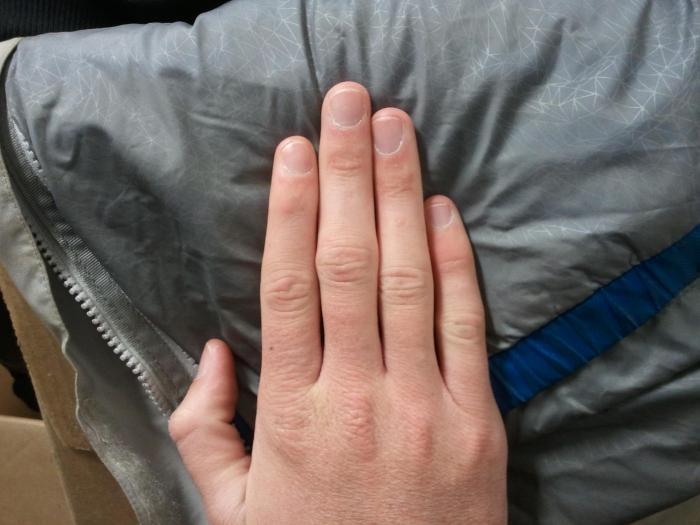 Потеря ногтя на среднем пальце правой руки