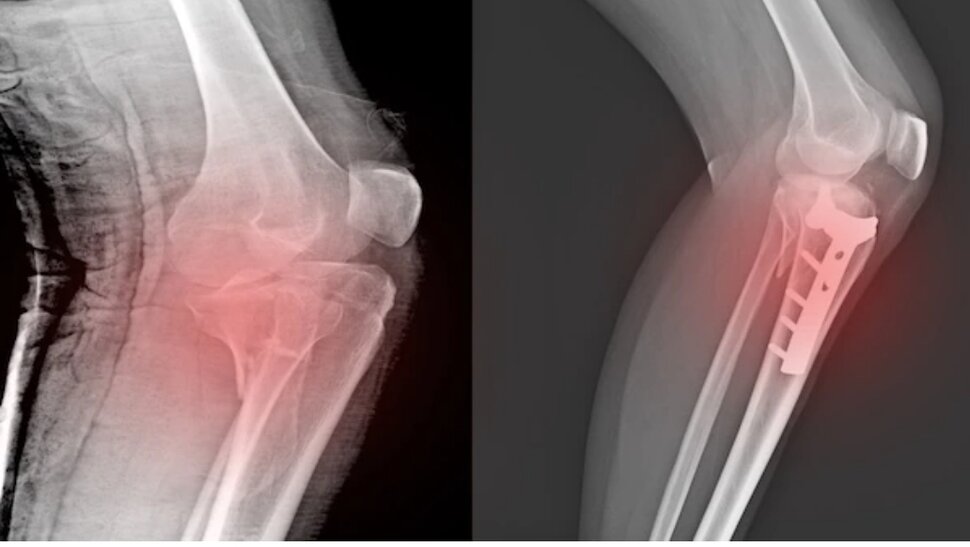Открытый перелом колена