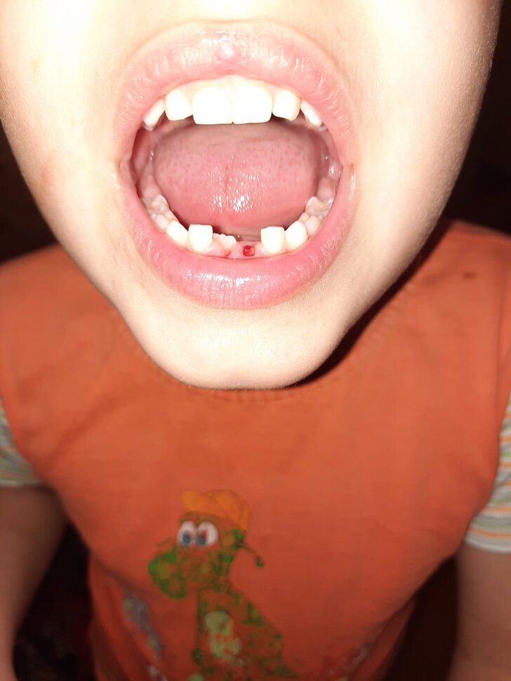 Нездоровые зубы, шатающийся зуб, зуб в два ряда