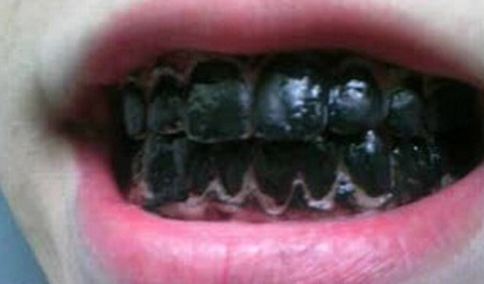 Чёрные зубы