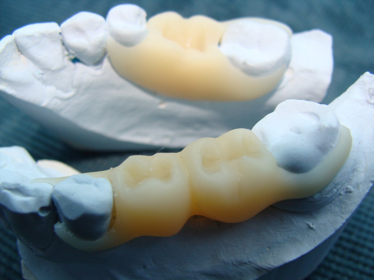 Бабочка на передний зуб. Иммедиат протез бабочка. Микропротез бабочка/ иммедиат-протез. Съемный микропротез 1 зуб. Иммедиат протезы ортопедическая стоматология.