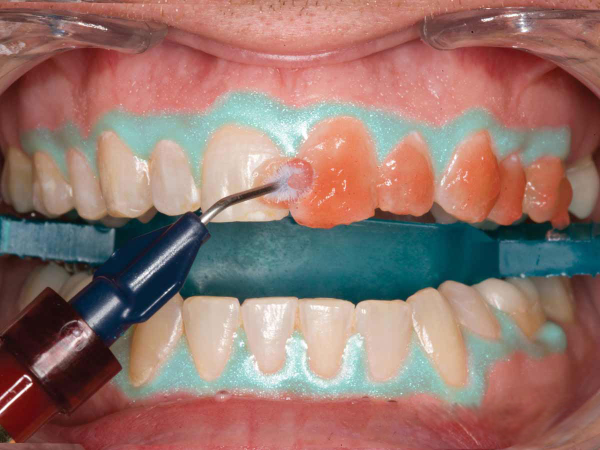 отбеливание зубов химический