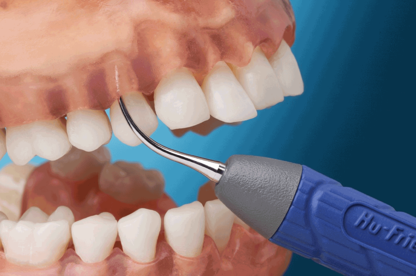 Как называется инструмент для чистки зубов ультразвуком. Профгигиена (ультразвук + Air-Flow). Профгигиена полости рта Air Flow.