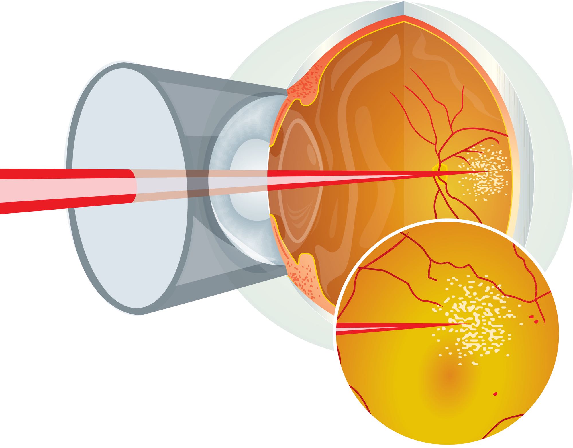 Лазерная коагуляция после операции. Лазерная коагуляция сетчатки глаза. Лазерная коагуляция сетчатки при диабетической ретинопатии. Периферическая лазерная коагуляция сетчатки. Периферическая лазеркоагуляция сетчатки ППЛК.
