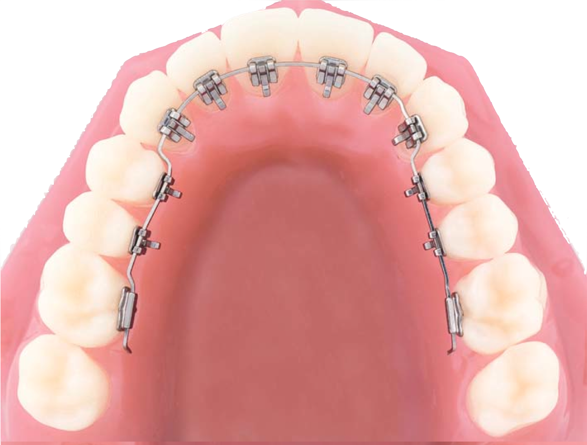 Можно ли поставить зуб. Лингвальные брекеты 2d Forestadent. Невидимые (лингвальные) брекеты. Брекеты лингвальные «in-Ovation l. Лингвальные (невидимые) брекеты stb.