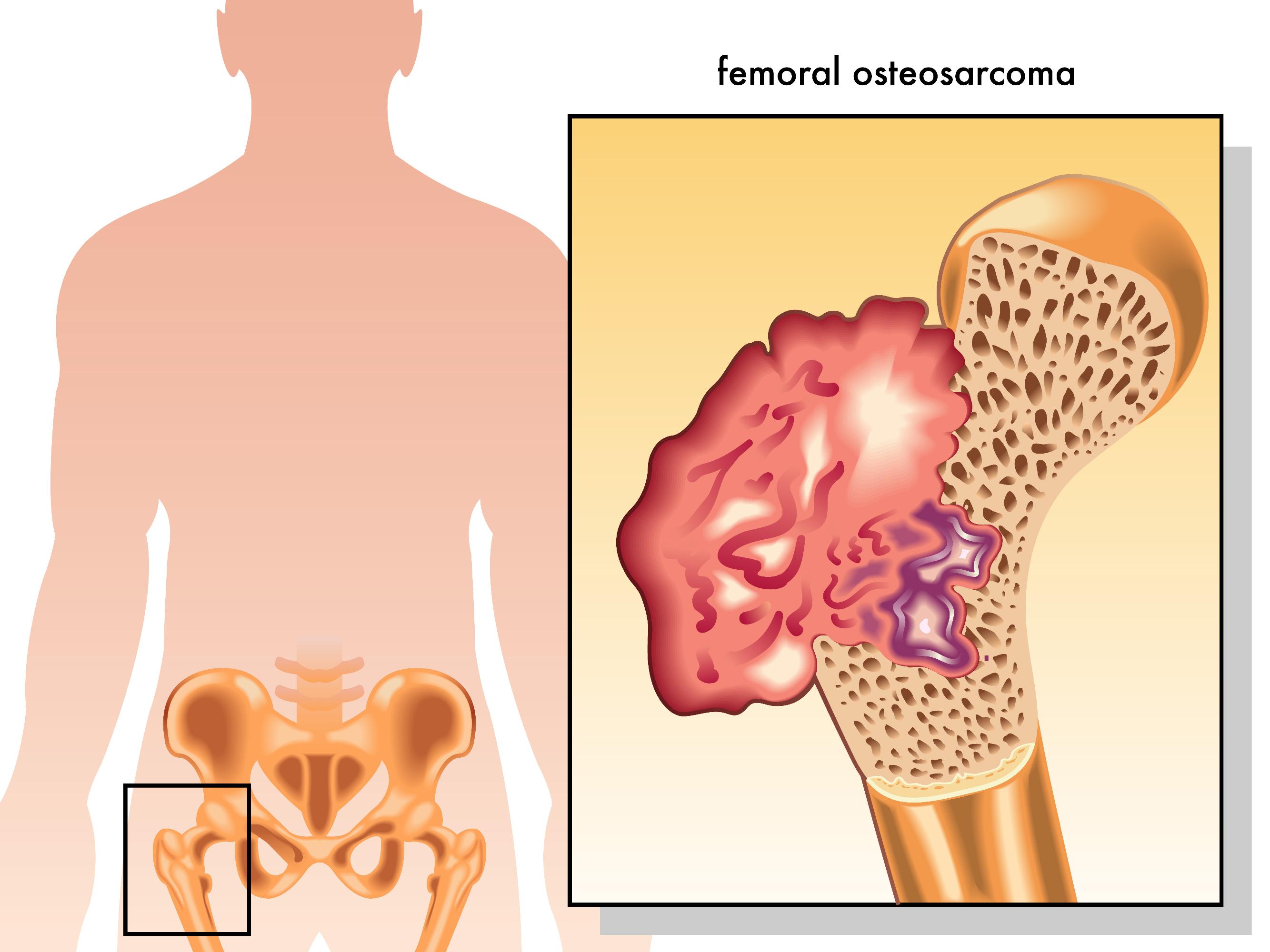 Чем отличается саркома. Остеосаркома тазобедренного сустава. Остеогенная саркома кости. Саркома костной ткани симптомы.